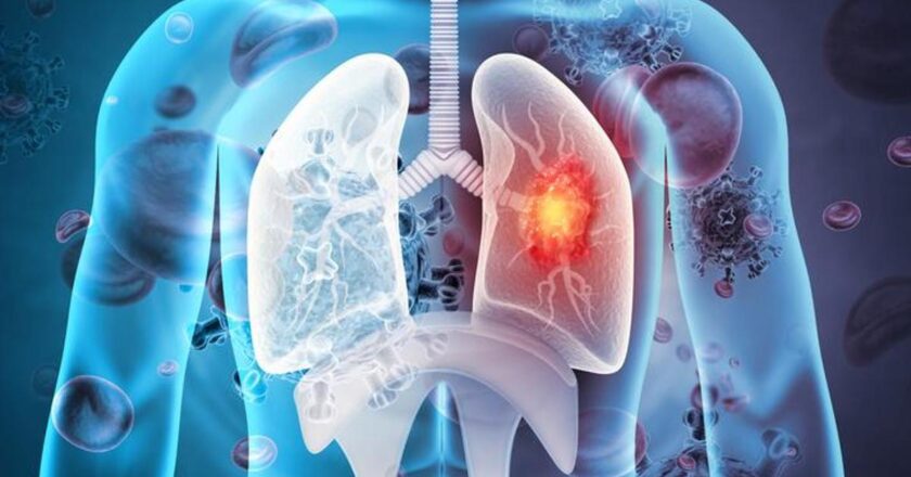 50 yaş üstü ve sigara kullanan kişiler dikkat! Uzmanlar uyarıyor: EN ÇOK AKCİĞER KANSERİ ÖLDÜRÜYOR –