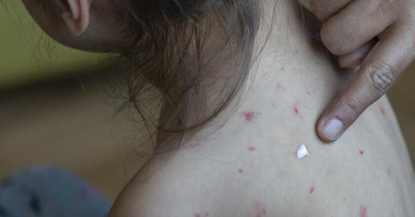Kızamık Belirtileri Nelerdir? Kızamık Nasıl Anlaşılır? Tedavi Yöntemleri Nelerdir?